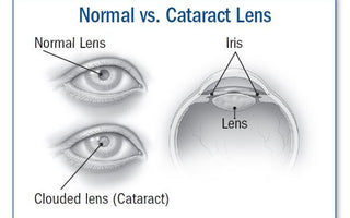 Cataracts Diagnosis & Testing - IseeU Optometry