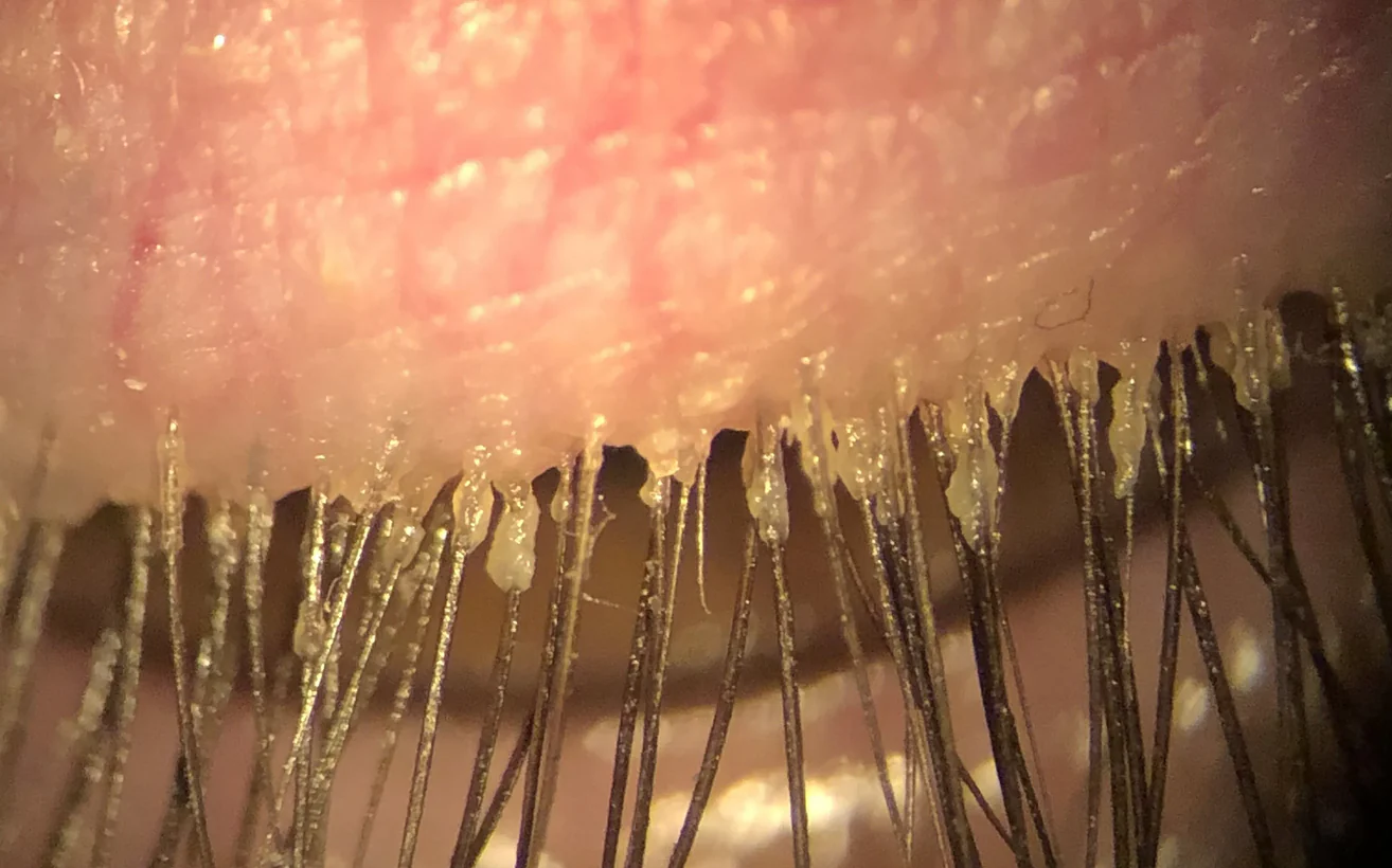 Eyelash Mites / Demodex Blepharitis: Causes, Symptoms, and Treatments – iSeeU Optometry