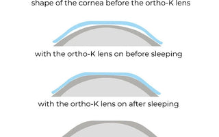 Ortho-K ORTHOKERATOLOGY in Palm Desert - IseeU Optometry